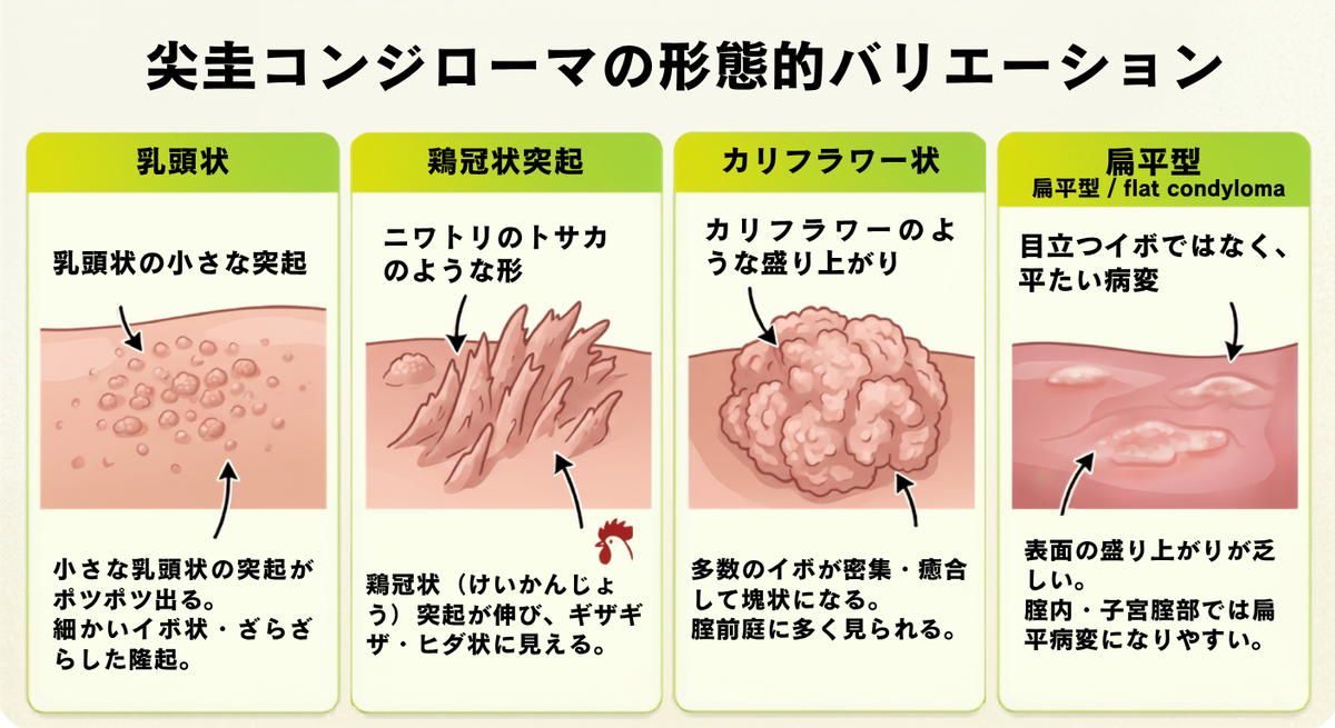 尖圭コンジローマの形態的バリエーション