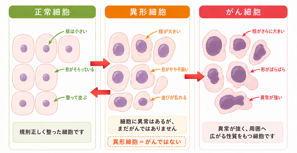 正常細胞から異型細胞に変化してさらにがん細胞に変化を表した図