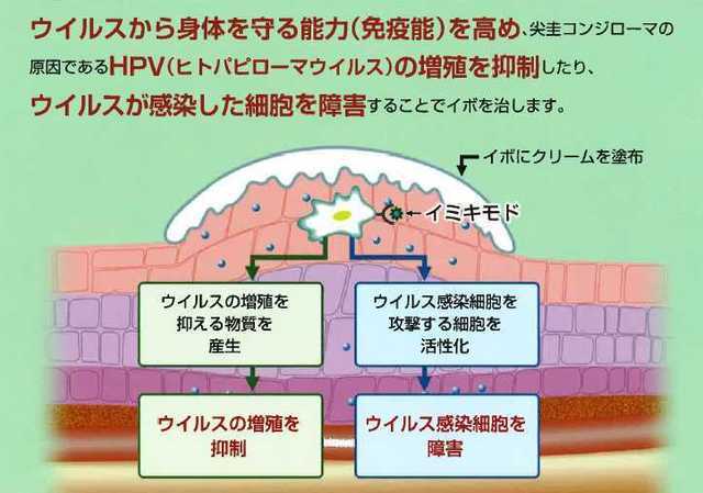 コンジローマ 尖 圭 尖圭コンジローマ